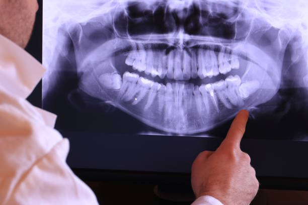 Best Knocked-Out Tooth (Avulsed Tooth) Treatment in Clton, IN