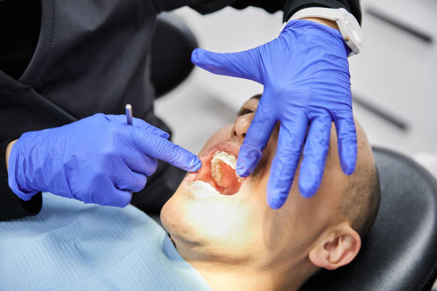 Best Knocked-Out Tooth (Avulsed Tooth) Treatment in Clton, IN